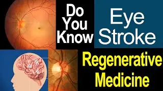 EYE STROKE - Causses Eye blindness Watch carfully - REGENERATIVE MEDICINE Helps to recover