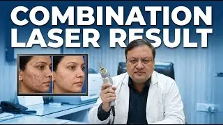 Amritsar Client | Acne Scar Treatment Fail Ho Gayi 😔 | Combination Laser Se Mila Asli Result!