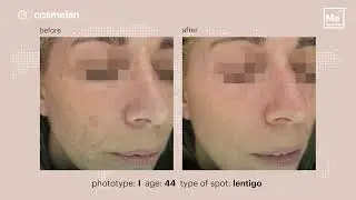 Cosmelan Depigmentation Peel | Chigwell Essex