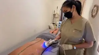 Ultrasonic Cavitation treatments in Bali