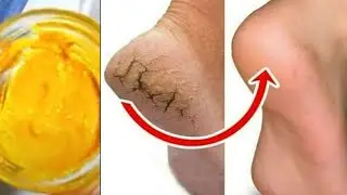 how to get rid of dry feet and cracked heels fast - Magical Cracked Heels Home Remedy