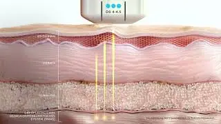 Ultherapy&reg; Prime &ndash; Non-Invasive Skin Tightening Treatment | The Retreat Berlin