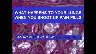 What happens to your lungs when you shoot up pain pills