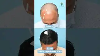 ✅ Incredible Hair Transplant 1-Year Journey | 3000 Grafts Implanted | Boosted FUE Method