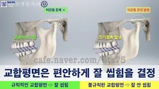 [내일남] 교합평면 (규칙적인/불규칙한)은 음식물을 편안하게 잘 씹을 수 있는지를 결정하며 보철치료-임플란트-교정치료의 기본입니다. 규칙적인 교합평면을 형성하는 방법도 소개합니다