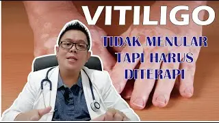 VITILIGO......... DEFINISI ? PENYEBAB ? GEJALA ? PENCEGAHAN ? DAN PENATALAKSANAANNYA