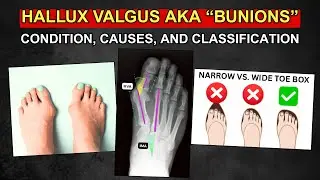 Hallux Valgus (Part 1) - Condition, Causes, and Classification