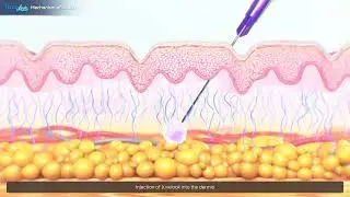How Juvelook&trade; Works | The Science of PDLLA Collagen Stimulation
