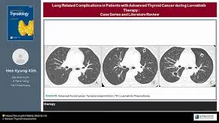 Lung Related Complications in Patients with Advanced Thyroid Cancer during Lenvatinib Therapy: Case