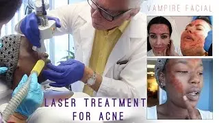 Transform Your Skin With Vampire Facial Co2 Laser Treatment For Acne Scars At Metromd.net