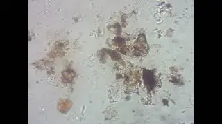 Massive secondary Gold concentration in deep drilled core  lensoid tilloid samples 