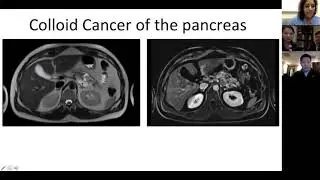 IPMN w/ enhancement - colloid variant of pancreatic cancer (Dr. Aarti Sekhar)