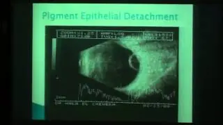 Echographic Evaluation o intraocular tumours Dr Hala Elcheweikh