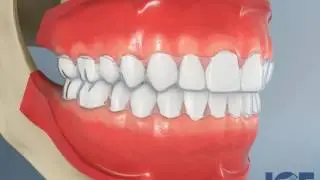 Invisalign&reg; - Discretely Straighten Your Teeth - The Art of Dentistry - San Diego, CA