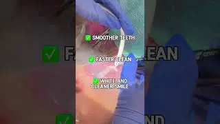 💨 Prophy Air Polisher: The Secret to a Whiter, Smoother Smile! 😁✨