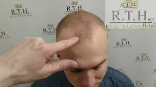 Пересадка волос в 23 года. Клиника Real Trans Hair в Москве