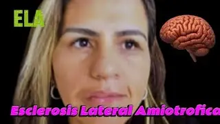 ELA(Amyotrophic Lateral Sclerosis)