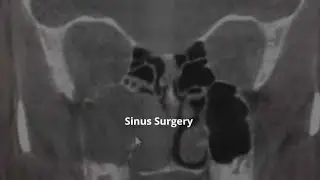 Dr. Anand of GNO Snoring & Sinus Discusses Sinus Surgery Results
