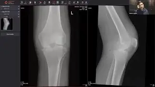 Knee pain explained, Plain Film X-Ray by Dr Lasker #medicalimaging #radiology #ctimaging #education