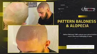 Best Scalp Micropigmentation London UK. Simon Symeou SMP Services for Men & Women. Non Surgical SMP.