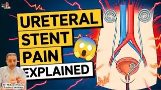⭐Double J (Ureteral) Stent: Local or General Anesthesia? Is It Painful?