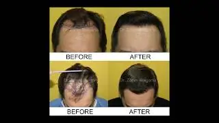 Dr. Zarev hair transplant 2750 grafts / Д-р Зарев трансплантация на коса 2750 присадки