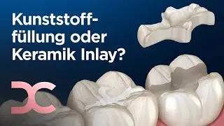 Kompositf&uuml;llung oder Keramik Inlay - was ist besser? Alles zur richtigen Zahnf&uuml;llung