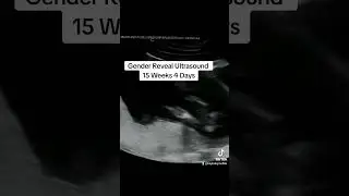 Gender Reveal Ultrasound at 15 weeks 4 days pregnant!