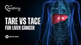 TARE vs. TACE for Liver Cancer | #livercancertreatment #livercancer #medicaltourism #wellness