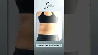 Lipoma Removal Surgery Results #LipomaRemoval