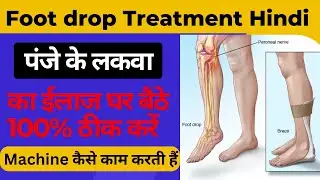 foot drop treatment in hindi || foot drop ka ilaj || फुट ड्राप कैसे ठीक होता है