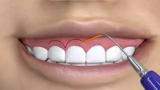 Gingivectomy | PERIODONTICS | DENVAK