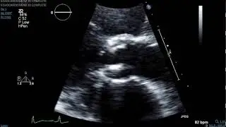 Brown Clinical Image of the Month: Lambls Echo 3