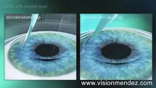 LASIK vs FEMTO-LASIK