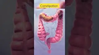 This is how constipation looks inside #viral #shortsvideo