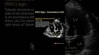 RAC Sign of Anomalous LCA #echocardiography #cardiology #science