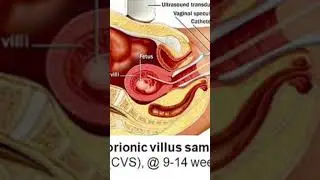 CVS bad amniocentesis in pregnancy #amniocentesis #cvs