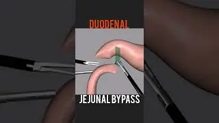Laparoscopic Duodenal Jejunal Bypass