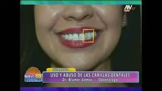 USO Y ABUSO DE LAS CARILLAS DENTALES