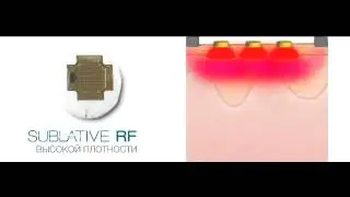 Мировые врачи о сублативном омоложении Matrix RF!