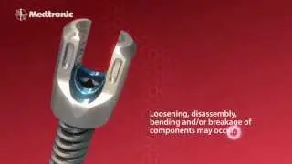 Medtronic - CDH Solera System Animation
