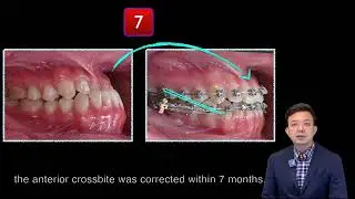 Severe Class III with -4 mm Overjet：OGS vs Ortho only｜【Chris Chang Ortho】CC702