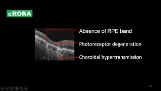 New Lexicon in Dry AMD, Part 1: cRORA