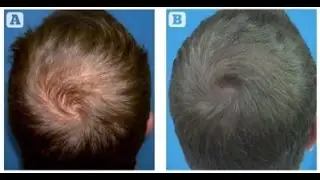 PRP + ACell Hair Growth Treatment In New York