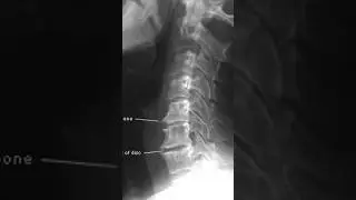 Calcification means long term inflammation #inflammation #arthritis #heartdisease #thyroid
