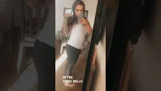 Mommy Makeover Review from Sono Bello | TriSculpt & AbEX Review