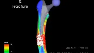 Quantitative CT-based Finite Element Analysis of Femoral Fracture after Arthroplasty