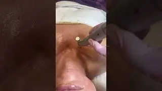 Microneedling with Skinbetter Alto advanced + Lavender jelly mask