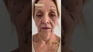 One of the most amazing transformations 🚀 from 74 years old to 30 ? #facelift #drsuleymantas