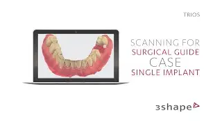 3Shape TRIOS - Scanning for surgical guide - Single implant case